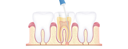 精密根管治療