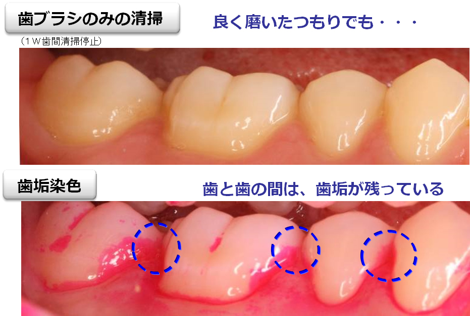 糸ようじと歯間ブラシは必要？ どう使えばいいの？