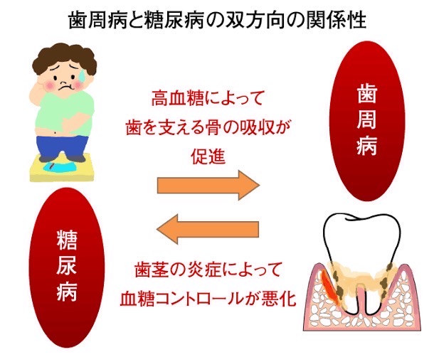 糖尿病と歯周病