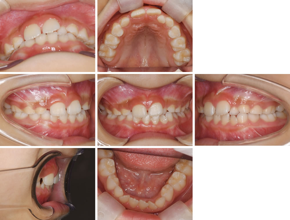 初診時の口腔内