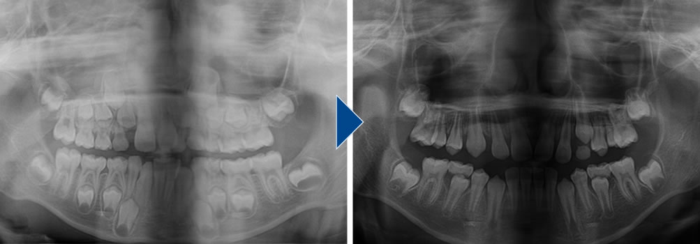 治療前後のレントゲン画像
