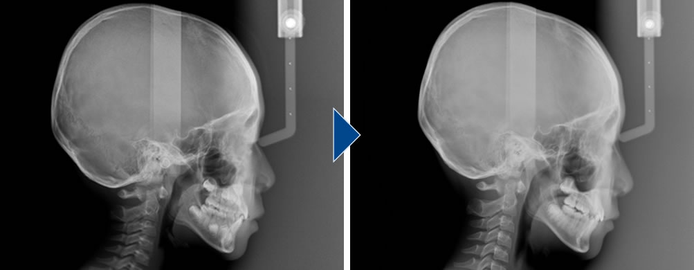治療前後のセファロレントゲン画像