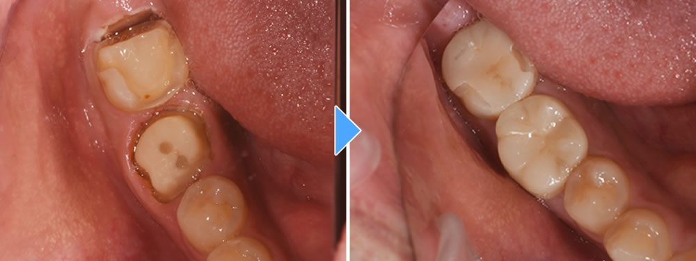 セラミックの装着・治療完了