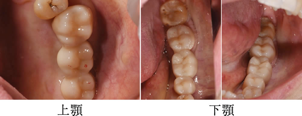 セラミックブリッジ装着・治療完了