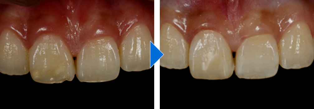 変色した前歯をダイレクトボンディングで改善した症例