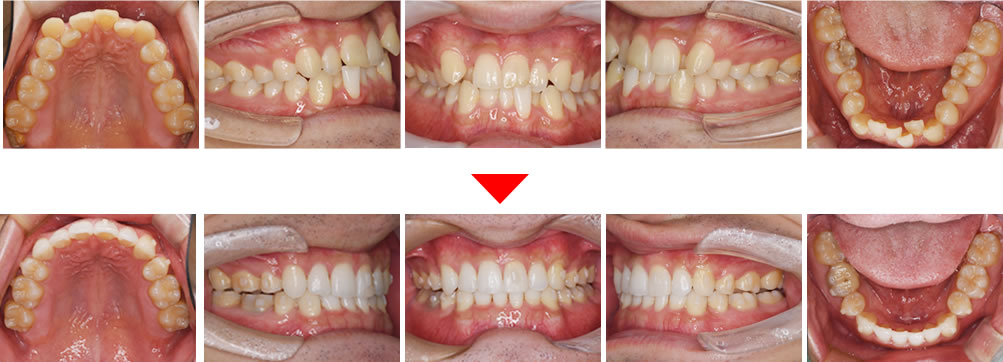マウスピース矯正とホワイトニングで歯並び・歯の色を改善した症例