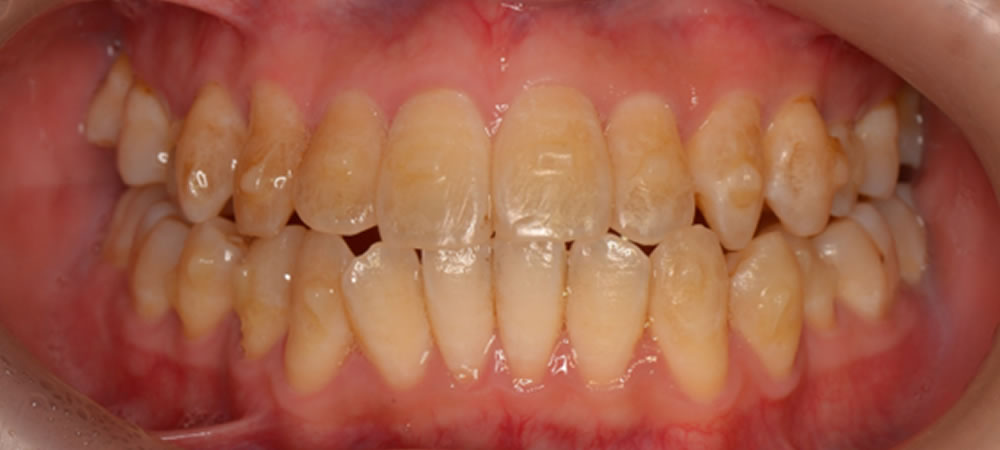 インビザラインとホワイトニングで歯並び・歯の色を改善した症例