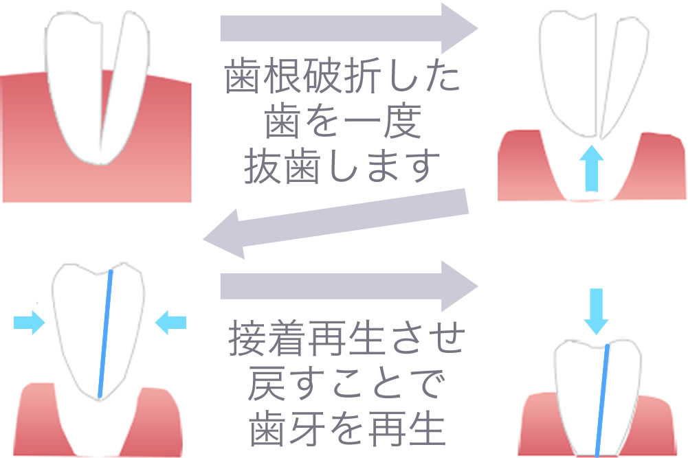 再植術