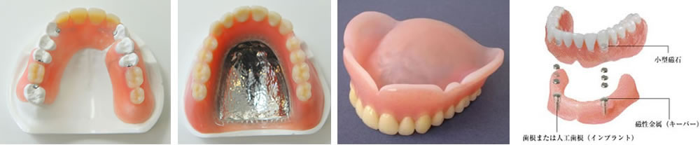 入れ歯の種類