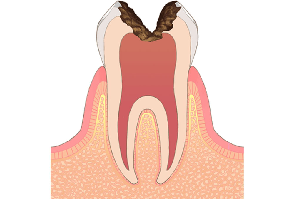 C3（歯の神経にまで達した虫歯）