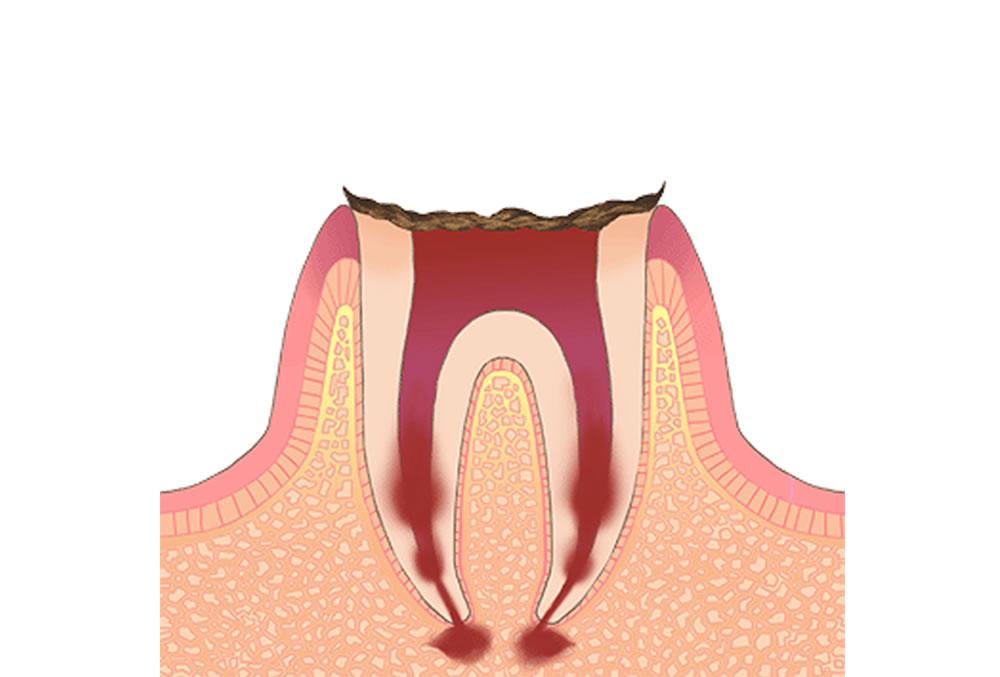 歯根部分しか残っていない状態の虫歯（C4）