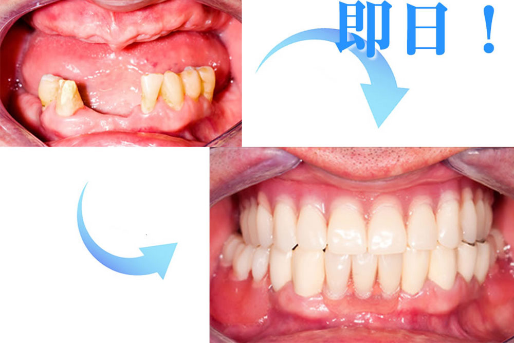 抜歯即時埋入