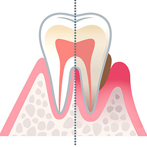 予防歯科診療・歯周病治療