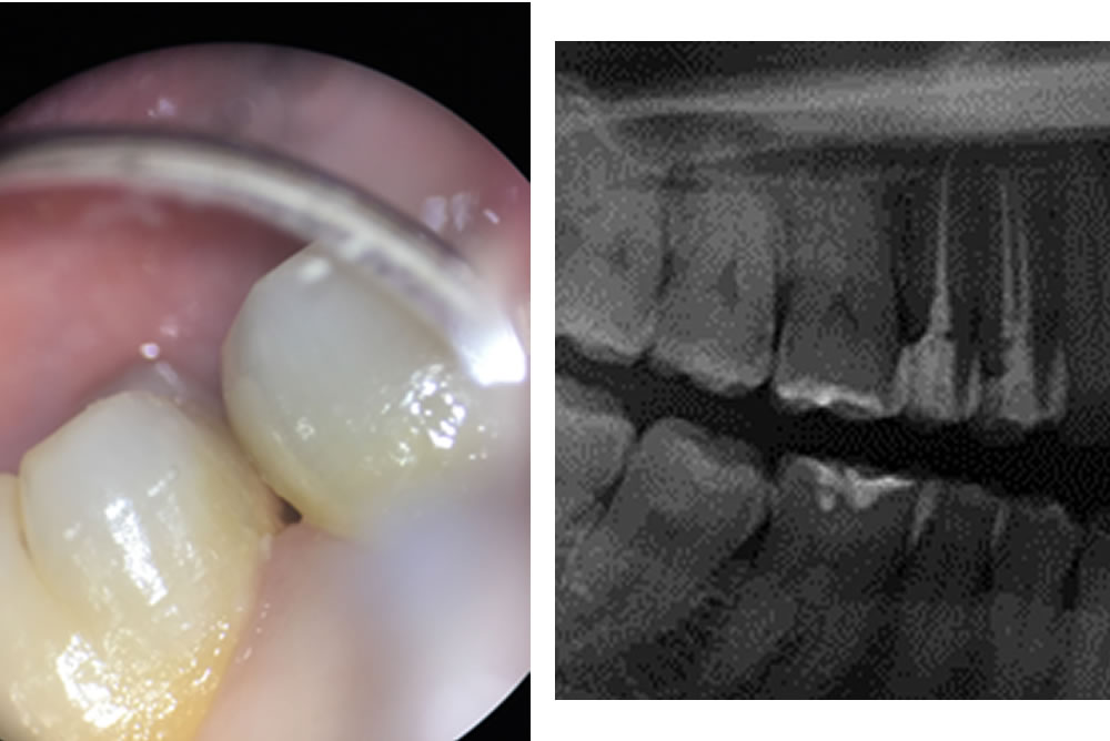 歯と歯の間が虫歯