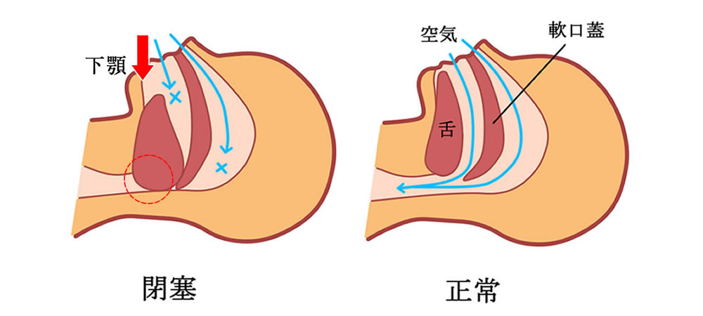 睡眠時無呼吸症候群(SAS)になりやすいお口の状態